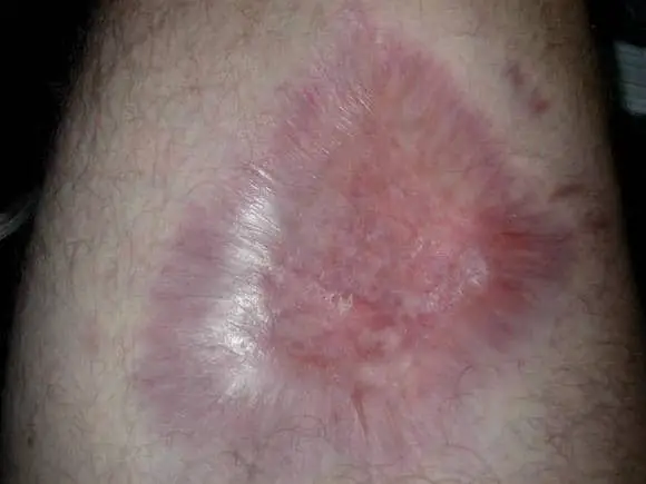 Recluse Bite on leg scar