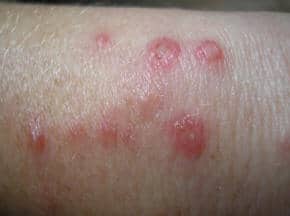 spider bite symptoms and treatment reaction