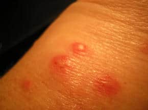 spider bite symptoms and treatment