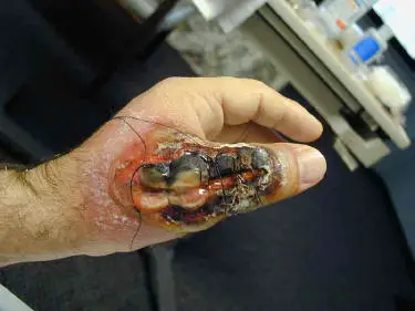 necrotic brown recluse bite on hand