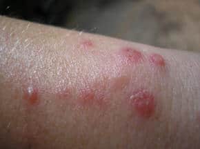 spider bite symptoms and treatment