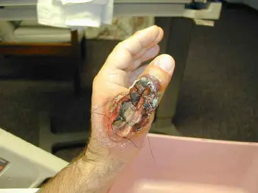 necrotic brown recluse bite on hand necrosis loxosceles thumb